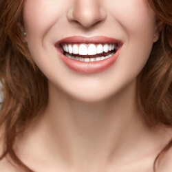 Veneers Services Visalia