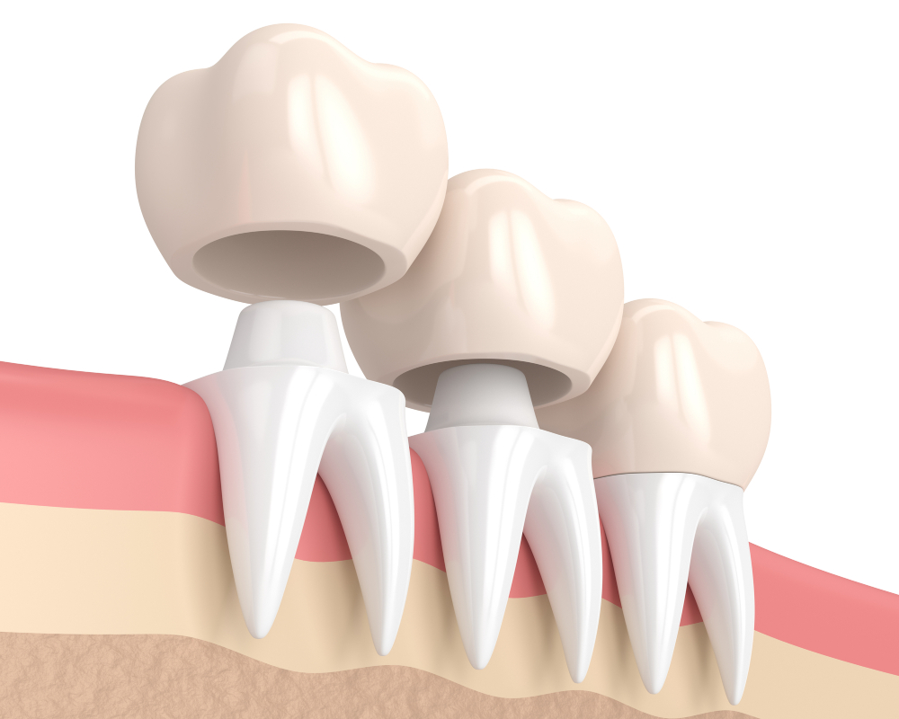 What are dental crowns made of