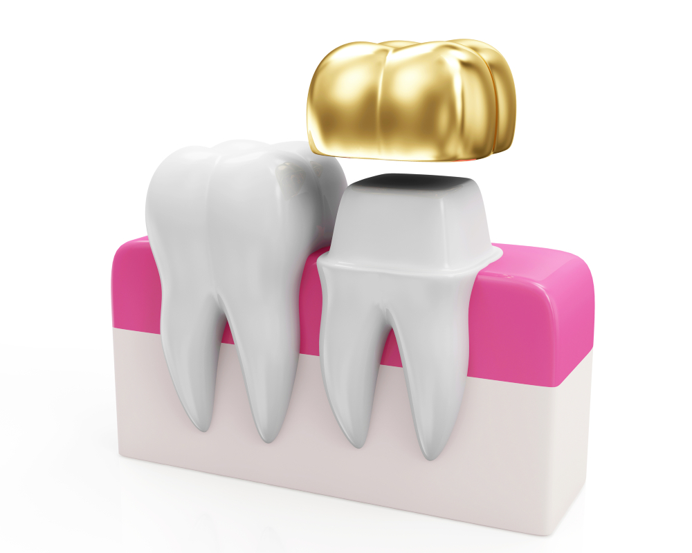 How much does it cost for a dental crown